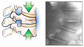 Osteoporosa - problem